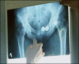 x-ray